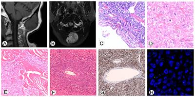 Case report: A rare case of malignant solitary fibrous tumor in an adult with an epithelioid pattern in the occipital region